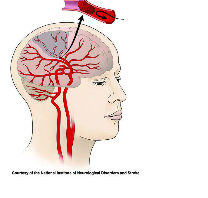 NICE's Stroke Treatment Update: Tenecteplase to Improve Patient Care and Cut Costs